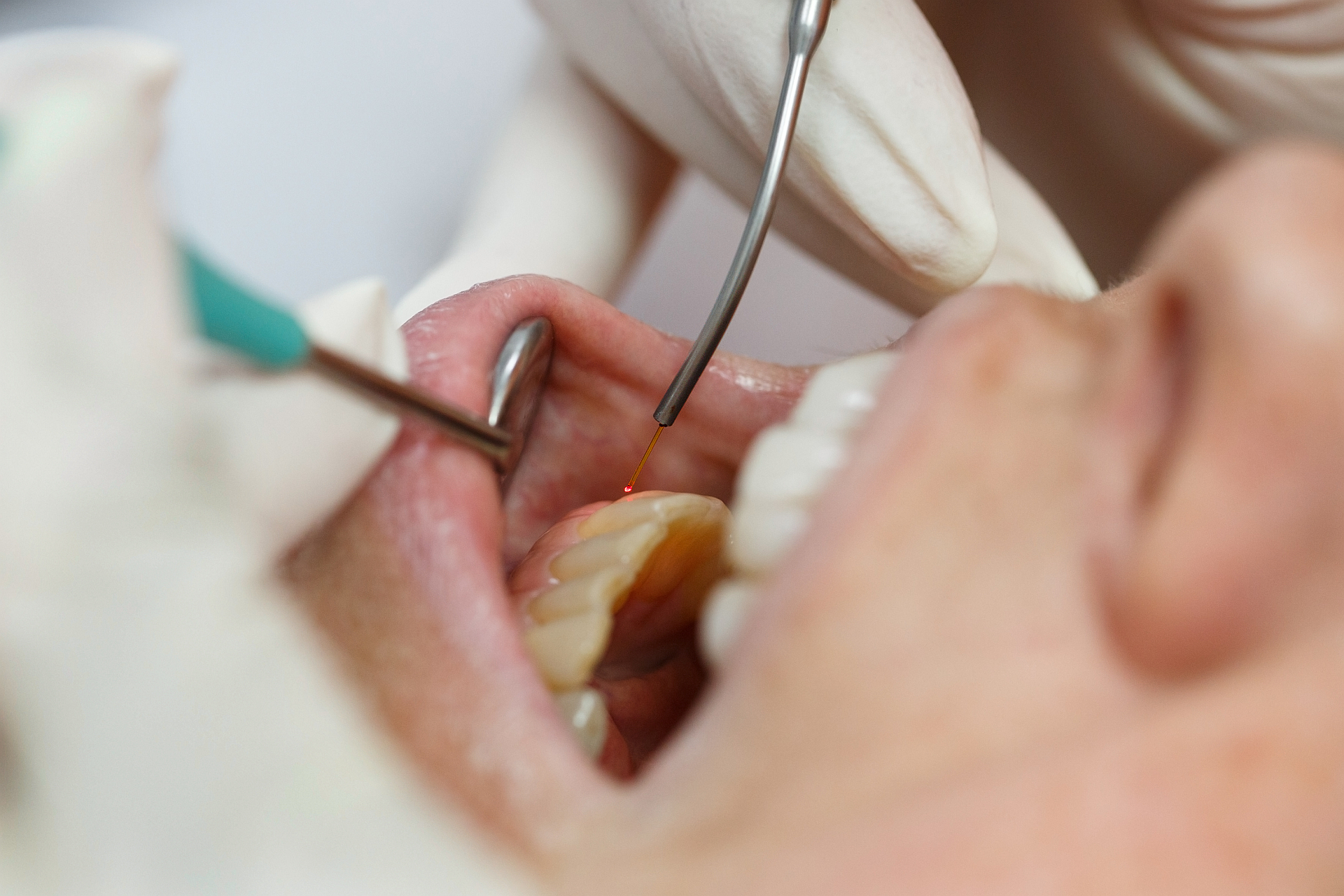 Laseroterapia